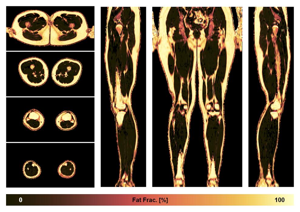 The fat fraction of the lower extremity obtained from the dixon reconstruction for muscle water fat quantification.